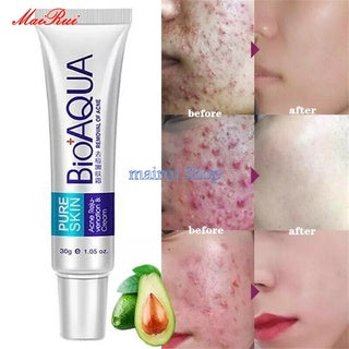 COMBO ANTIACNE BIOAQUA+ CAJA DE SEGURI